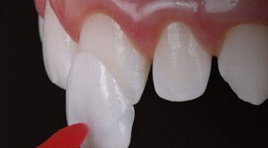 Facetas de Porcelana