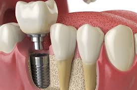 Coroa sobre Implantes: